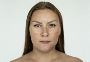 melasma